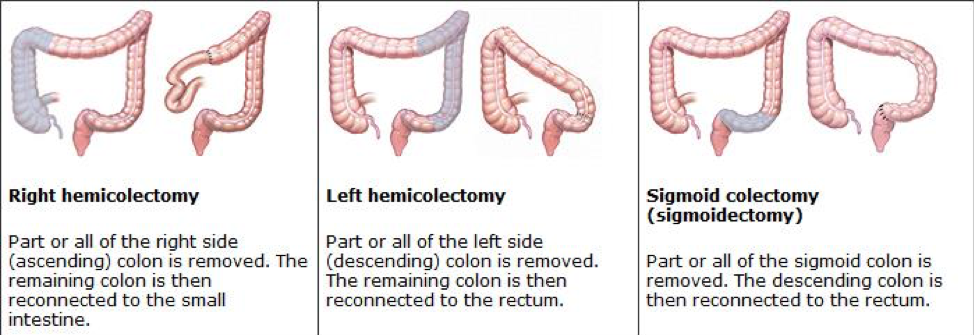 Types Of Colorectal Surgery